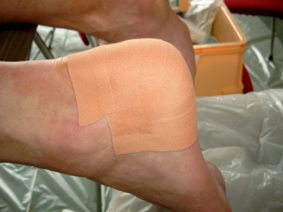 Blaarbehandeling